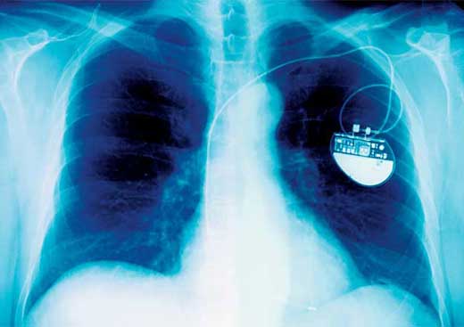 X-ray image showing a pacemaker attached to a person's heart.